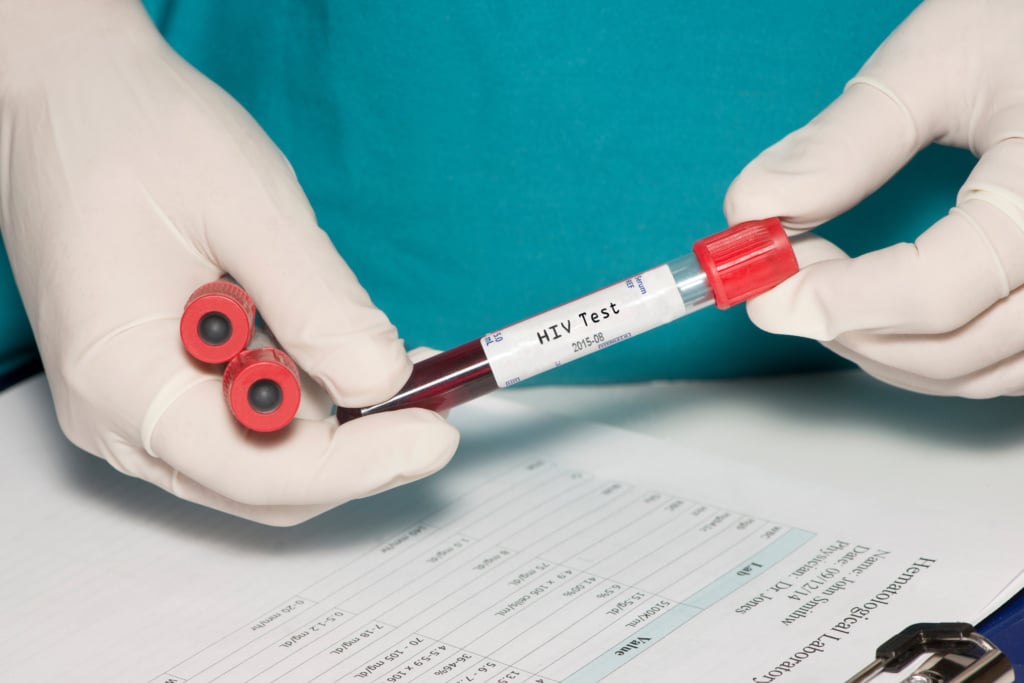 A blood collection tube used for HIV diagnostic testing. From blood sample presence of HIV antigens and antibodies are determined.